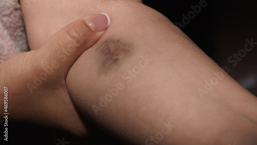 view of Woman in pain touching her bruised arm