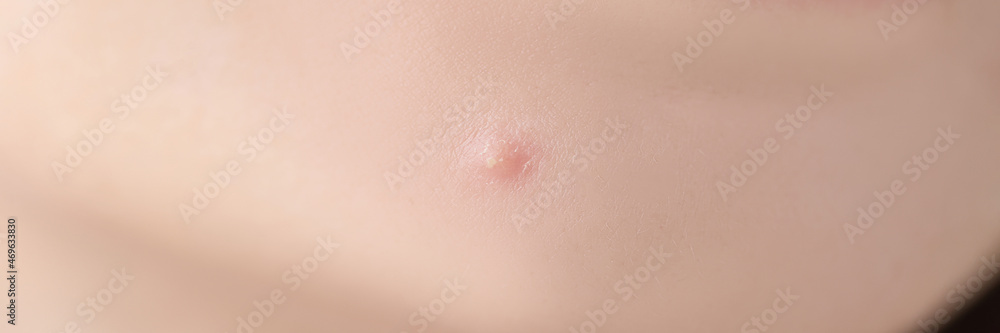 Closeup of white pimple on chin skin of young woman Closeup of white pimple on chin skin of young woman