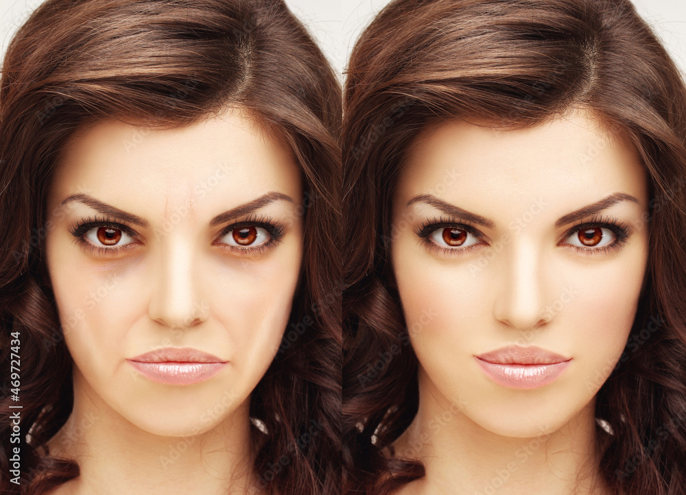 Effects of ageing,Frown lines ,Nasolabial folds,Neck ,Under eye circles,neck lines. Plastic Surgery Results Effects of ageing,Frown lines ,Nasolabial folds,Neck ,Under eye circles,neck lines. Plastic Surgery Results