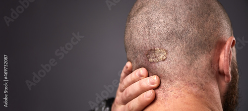 Man with dry flaky skin on his head with psoriasis and nail fungus on hands. Autoimmune genetic disease.