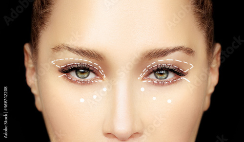фотографія Lower and upper  Blepharoplasty