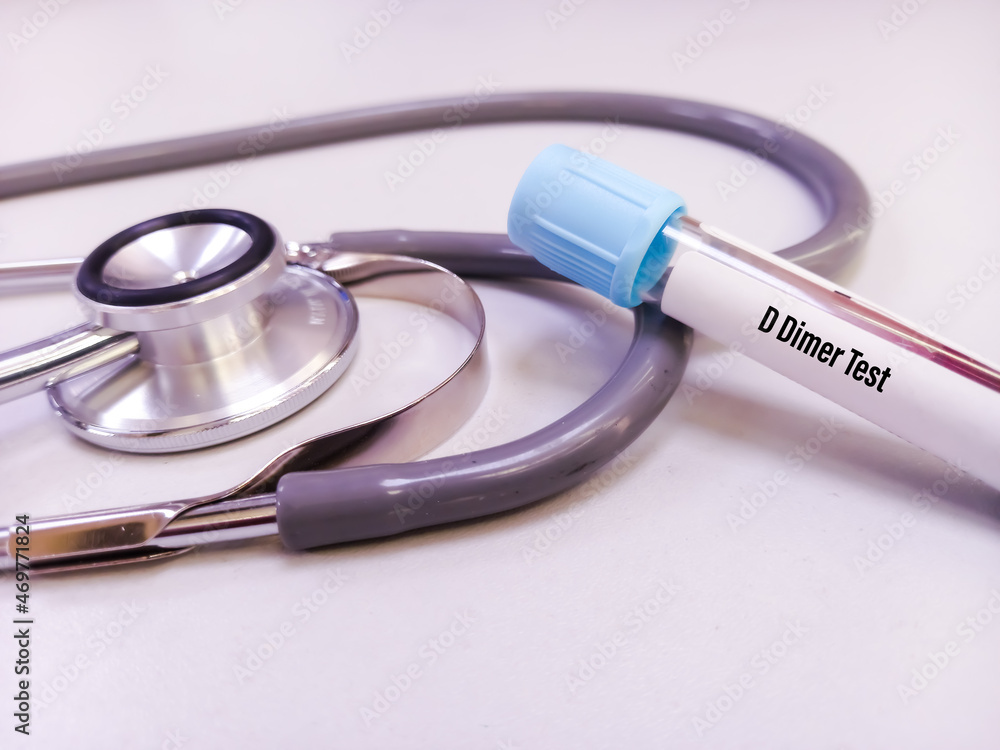 DDimer test. Corona patient monitoring test, close view. deep venous