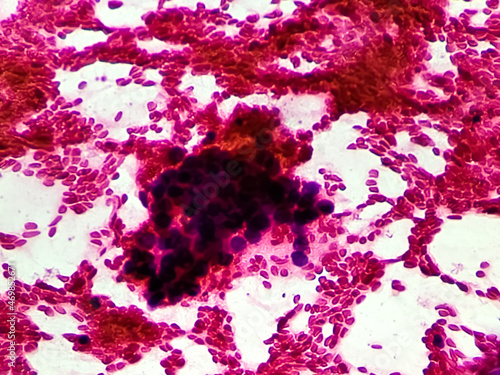 Hepatocellular Carcinoma Microscopic image of FNAC Fine Needle Aspiration Cytology test. Liver SOLs. Cancer photo