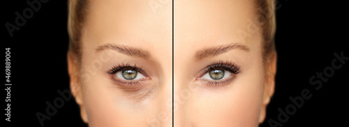Lower eyelid blepharoplasty.Upper  blepharoplasty.Before and after cosmetic procedures