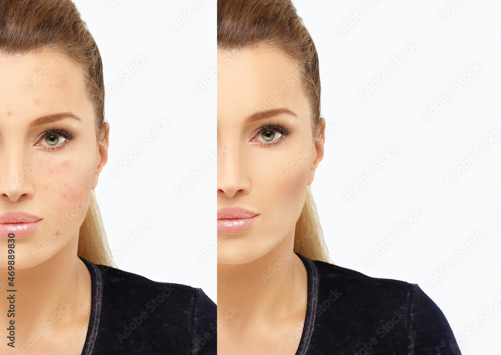 Post-Acne Marks /Treating Acne Scars Post-Acne Marks /Treating Acne Scars
