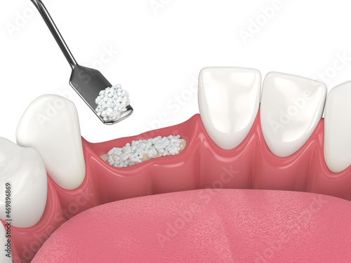 3D render of dental bone grafting with dental bone biomaterial photo