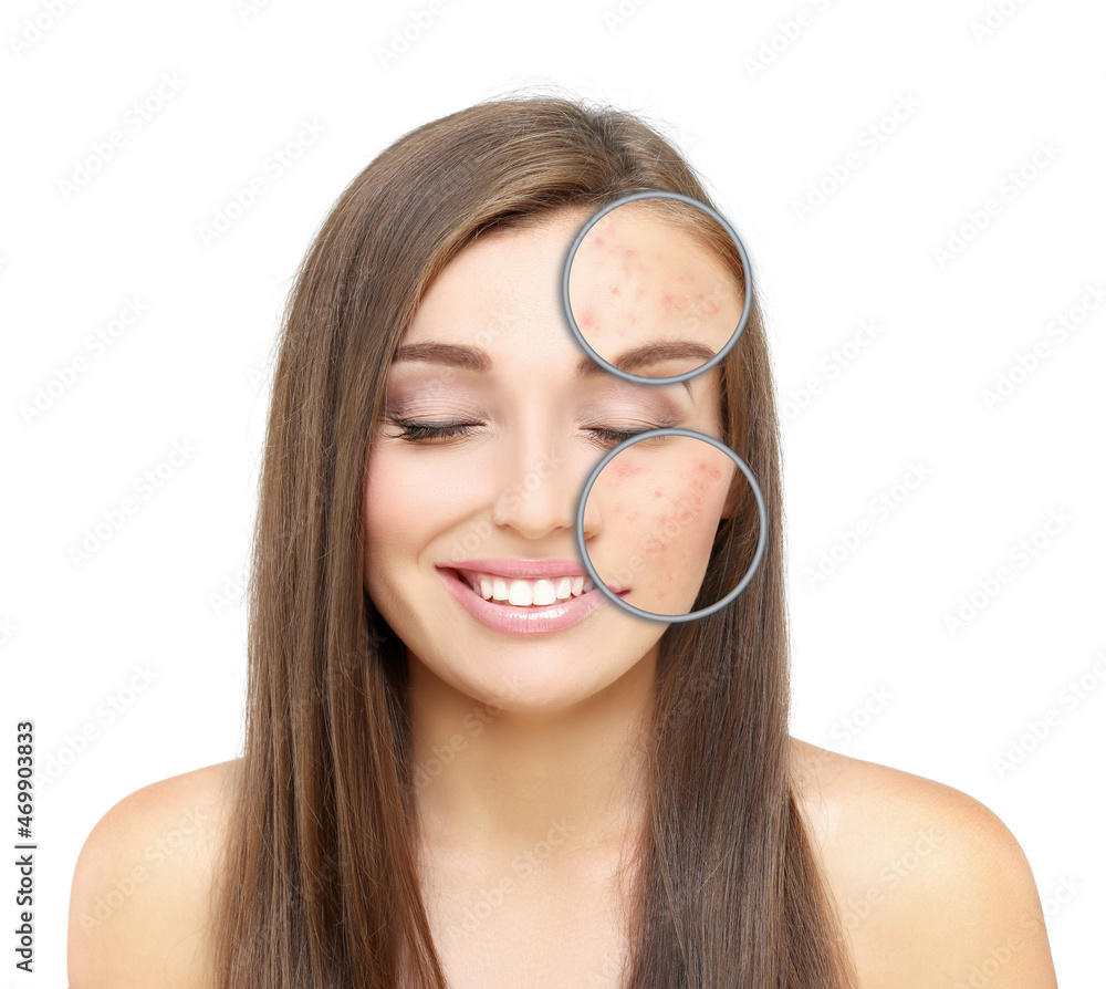 Post-Acne Marks .Treating Acne Scars.Acne Scar Removal. Post-Acne Marks .Treating Acne Scars.Acne Scar Removal.