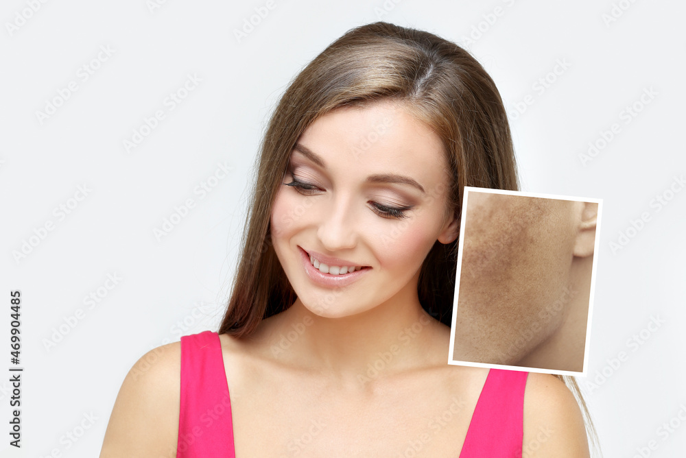 Fototapeta premium Dark spots, freckles,hyperpigmentation(melasma or chloasma),concept- skin lightening, skin whitening, Skin Brightening.