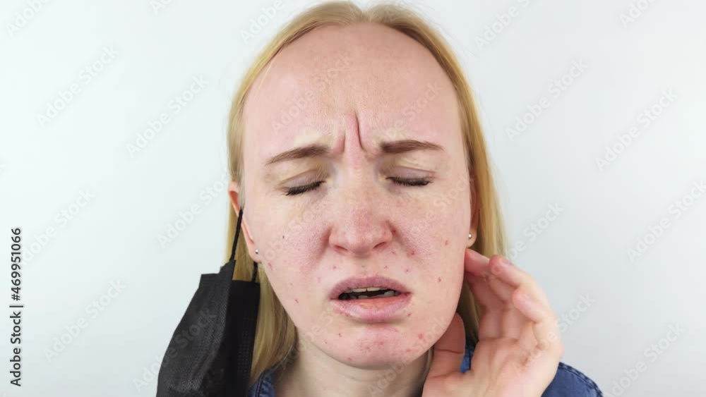 Woman removes the protective mask and shows irritation on face skin. Antiviral measures. Means of protection against covid 19. Long wearing of a mask. Acne on face and chafing. Dry lips and red dots Woman removes the protective mask and shows irritation on face skin. Antiviral measures. Means of protection against covid 19. Long wearing of a mask. Acne on face and chafing. Dry lips and red dots