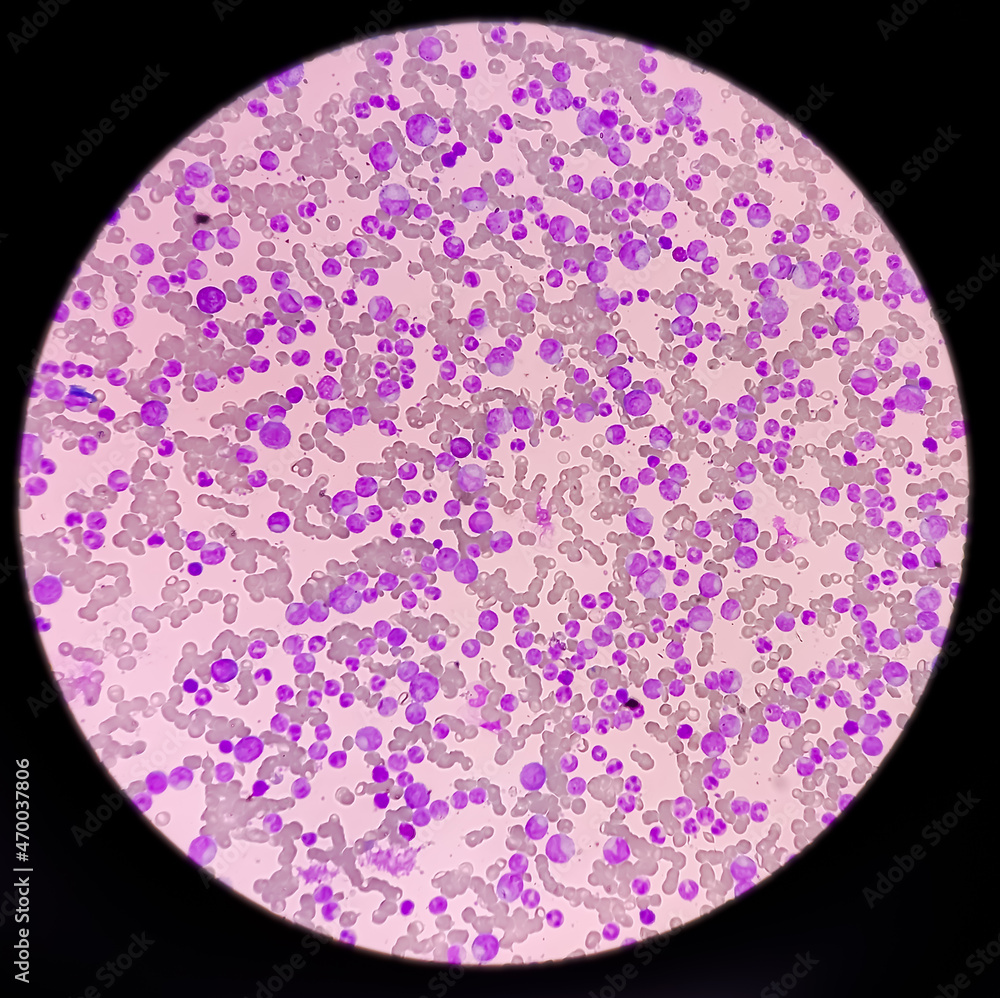Blood cancer. Chronic myelogenous leukemia, also known as Chronic myeloid leukemia(CML) with Thrombocytosis. Blood cancer. Chronic myelogenous leukemia, also known as Chronic myeloid leukemia(CML) with Thrombocytosis.
