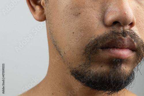 The face of a bearded man is full of various types of acne, such as inflammatory acne, blackheads, pimples, etc. There are also large pores on the face and flies due to lack of cleanliness.