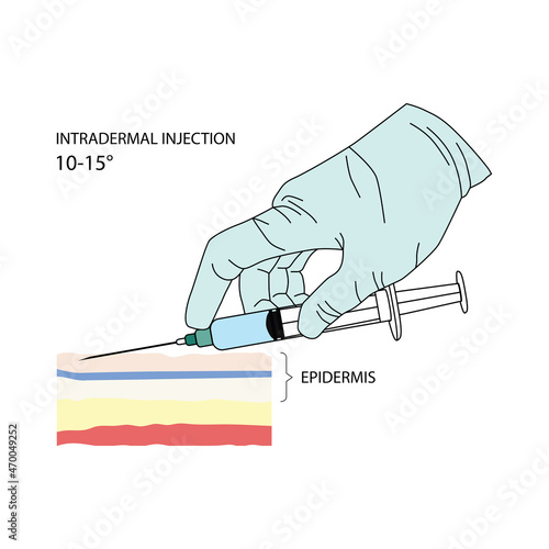 Intradermal injection. Effective methods of administration of drugs and other medical solutions that are used for humans and animals. Vector illustration isolated on white background. photo