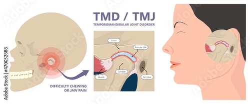 Temporomandibular Joint Disorders TMD TMJ treat pain displaced disc temporal bone locking bite plate plastic guard night Transcutaneous electrical nerve stimulation TENS Arthroscopy occlusal oral