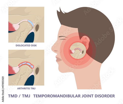 Temporomandibular Joint Disorders TMD TMJ treat pain displaced disc temporal bone locking bite plate plastic guard night Transcutaneous electrical nerve stimulation TENS Arthroscopy occlusal oral