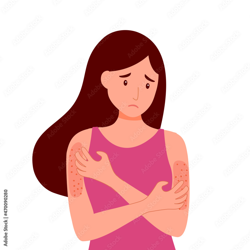 Young woman scratching arms suffering strong allergy skin itchy symptom in flat design. Red rash skin irritation. Young woman scratching arms suffering strong allergy skin itchy symptom in flat design. Red rash skin irritation.