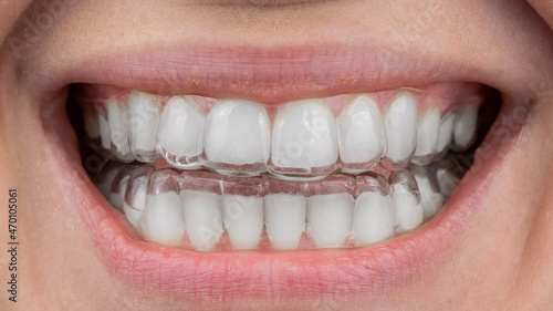 Close-up of a caucasian woman smiling with aligners on her teeth. Macro.
