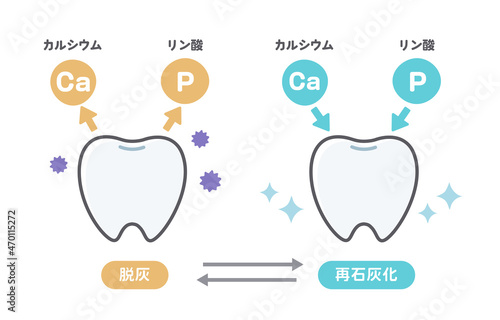 脱灰と再石灰化に関する歯のイラスト