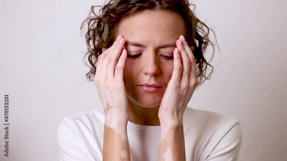 Girl with autoimmune disease vitiligo covers her face with her hands. Close-up portrait