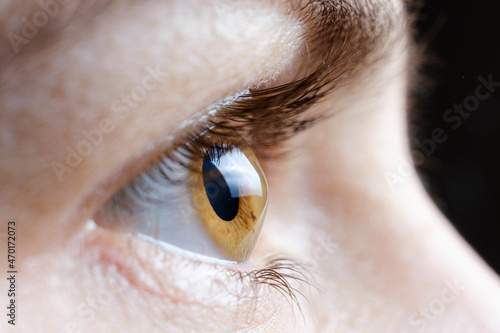 Macro photo of the human eye with corneal disease keratoconus photo