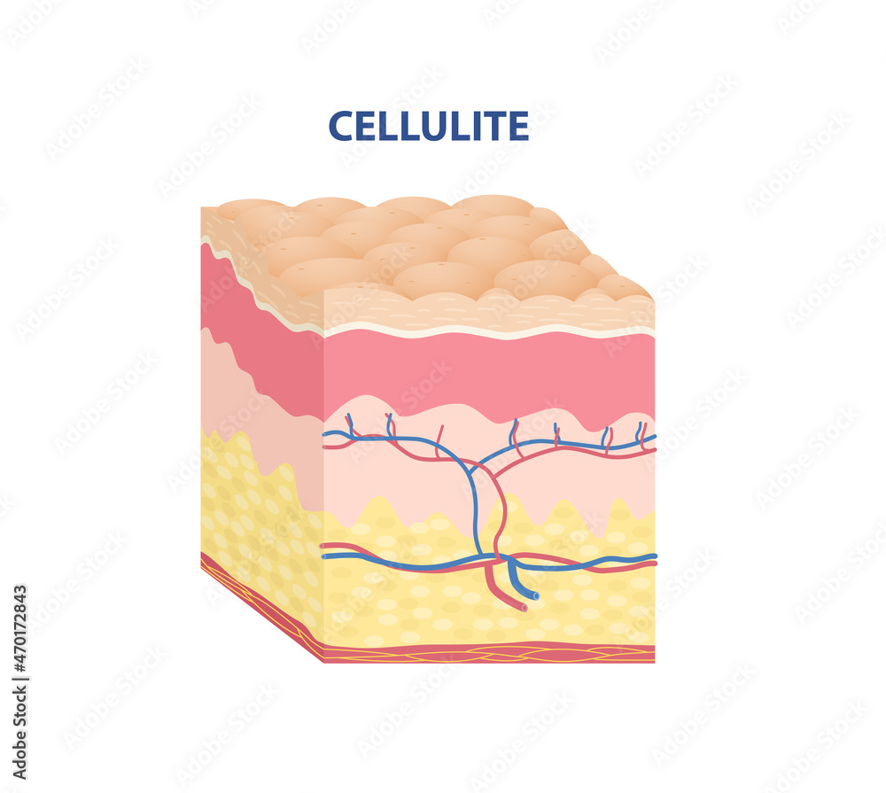 Skin Type Sticker. Uneven epidermis with cellulite. Rough subcutaneous layer. Design element for scientific websites and apps. Cartoon isometric vector illustration isolated on white background - obrazy, fototapety, plakaty 