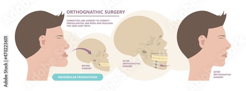 Jaw Surgery chin implant Sleep Apnea snoring upper airway plastic facial Cranio TMD TMJ joint Overbite teeth dental birth defects Open bite pain trauma cosmetic gummy smile bone reconstructive bad