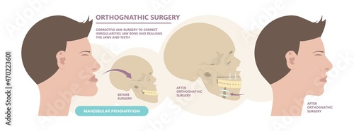 Jaw Surgery chin implant Sleep Apnea snoring upper airway plastic facial Cranio TMD TMJ joint Overbite teeth dental birth defects Open bite pain trauma cosmetic gummy smile bone reconstructive bad photo