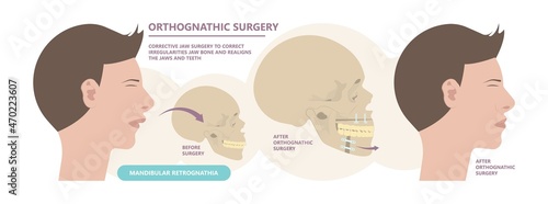 Jaw Surgery chin implant Sleep Apnea snoring upper airway plastic facial Cranio TMD TMJ joint Overbite teeth dental birth defects Open bite pain trauma cosmetic gummy smile bone reconstructive bad