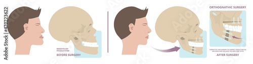 Jaw Surgery chin implant Sleep Apnea snoring upper airway plastic facial Cranio TMD TMJ joint Overbite teeth dental birth defects Open bite pain trauma cosmetic gummy smile bone reconstructive bad