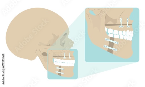 Jaw Surgery chin implant Sleep Apnea snoring upper airway plastic facial Cranio TMD TMJ joint Overbite teeth dental birth defects Open bite pain trauma cosmetic gummy smile bone reconstructive bad photo