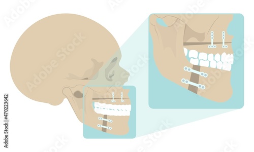 Jaw Surgery chin implant Sleep Apnea snoring upper airway plastic facial Cranio TMD TMJ joint Overbite teeth dental birth defects Open bite pain trauma cosmetic gummy smile bone reconstructive bad