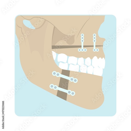 Jaw Surgery chin implant Sleep Apnea snoring upper airway plastic facial Cranio TMD TMJ joint Overbite teeth dental birth defects Open bite pain trauma cosmetic gummy smile bone reconstructive bad