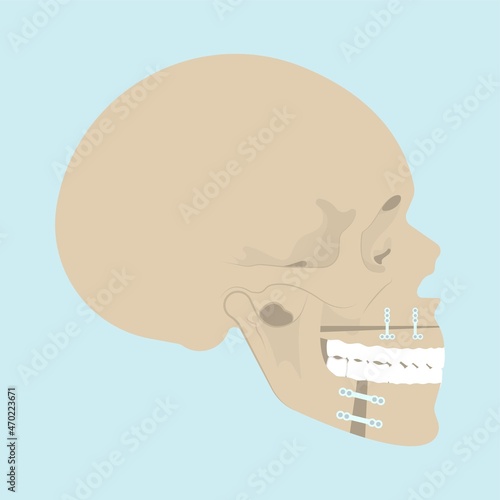 Jaw Surgery chin implant Sleep Apnea snoring upper airway plastic facial Cranio TMD TMJ joint Overbite teeth dental birth defects Open bite pain trauma cosmetic gummy smile bone reconstructive bad
