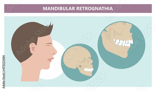 Jaw Surgery chin implant Sleep Apnea snoring upper airway plastic facial Cranio TMD TMJ joint Overbite teeth dental birth defects Open bite pain trauma cosmetic gummy smile bone reconstructive bad
