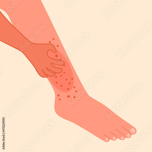 Hand scratching leg in flat design. Man or woman suffering from strong allergy skin itchy symptom concept. Red rash skin irritation.