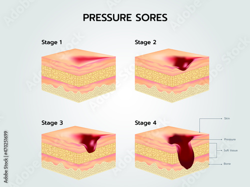 bedsore Stages of Pressure Sores photo