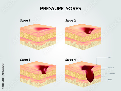 bedsore Stages of Pressure Sores