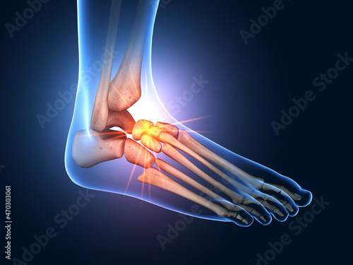 Painful foot joints, medical 3D illustration