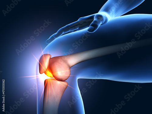 Painful knee joint, medical 3D illustration
