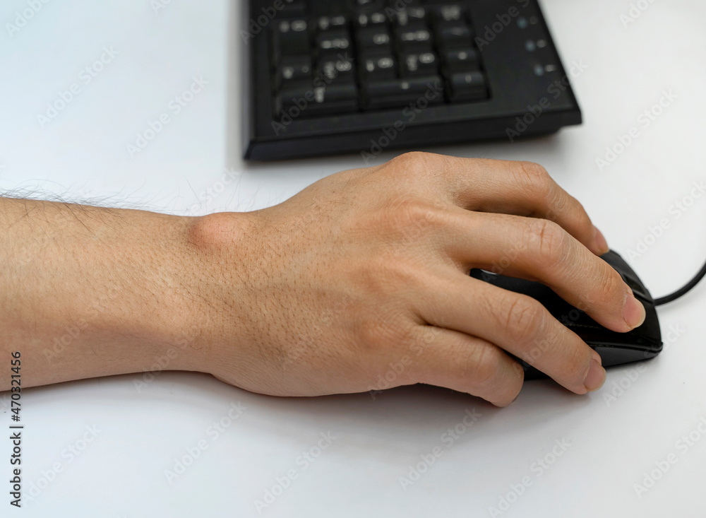 gemiddelde Harnas Leer Ganglion cyst on man's hand. Hand holding computer mouse Stock Photo |  Adobe Stock