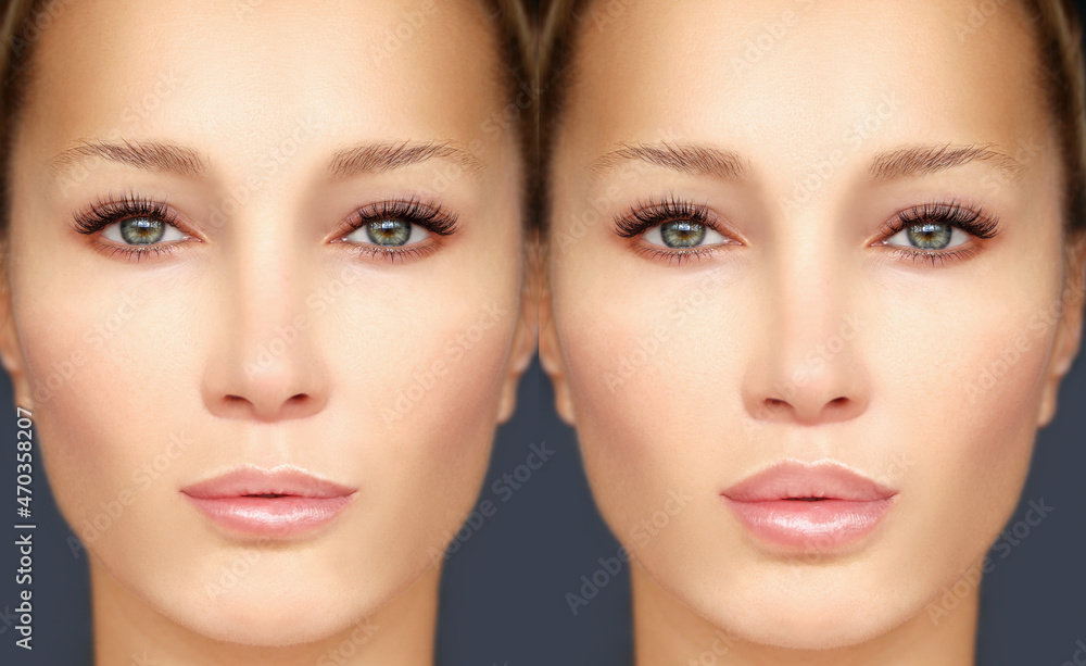 Beauty injections.Concept of rejuvenation.Lip augmentation Beauty injections.Concept of rejuvenation.Lip augmentation