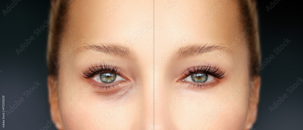 Lower and upper  Blepharoplasty..Before and after cosmetic procedures,showing photos
