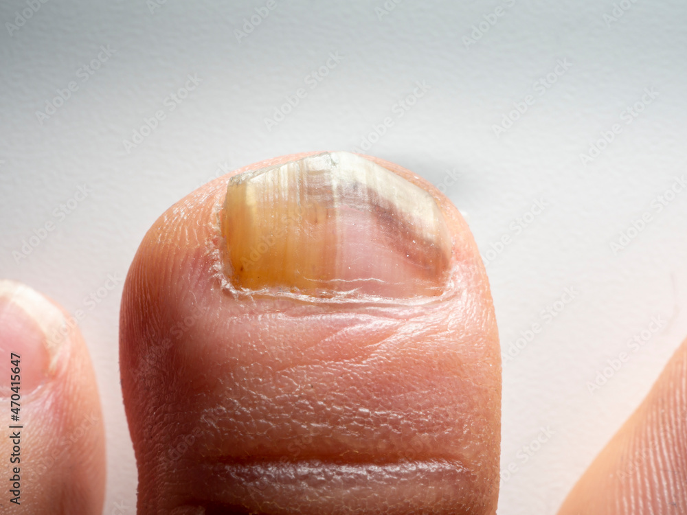 Nail infections caused by fungi such as: onychomycosis also known as tinea unguium. Caused by dermatophytes and yeasts and for the concomitant antibacterial activity Nail infections caused by fungi such as: onychomycosis also known as tinea unguium. Caused by dermatophytes and yeasts and for the concomitant antibacterial activity