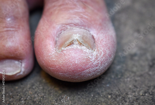 Fungal nail infection. Onychomycosis, also called Tinea unguium. photo