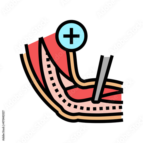 ulnar nerve release color icon vector. ulnar nerve release sign. isolated symbol illustration