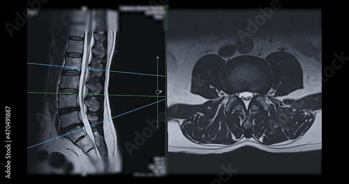 MRI L-S spine or lumbar spine Axial T2W view with sagittal plane for diagnosis spinal cord compression. photo