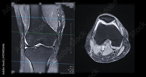 MRI knee or Magnetic resonance imaging of knee joint   for detect acl ligament tear. photo