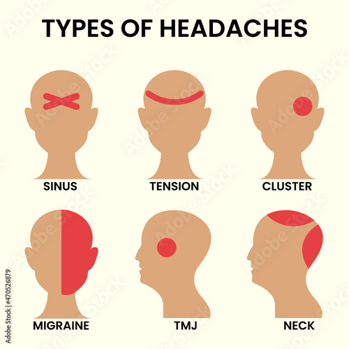 Types of headaches