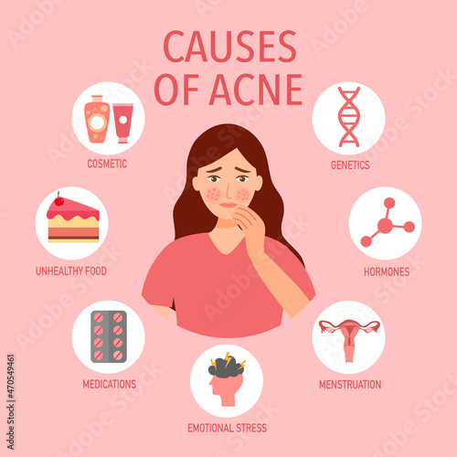 Causes of acne infographic in flat design. Source of pimple skin problem concept vector illustration.