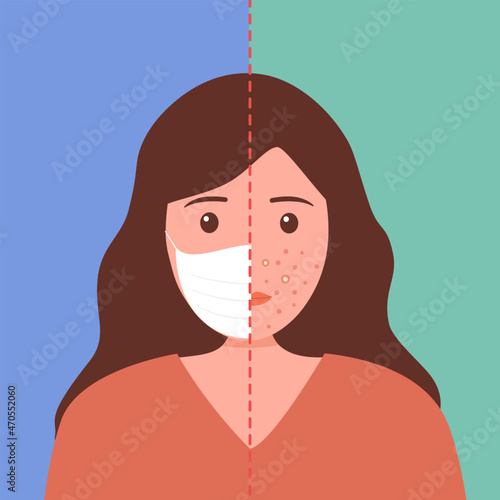 Woman having acne problem caused by face mask in flat design. Maskne (mask and acne) skin problem concept vector illustration.