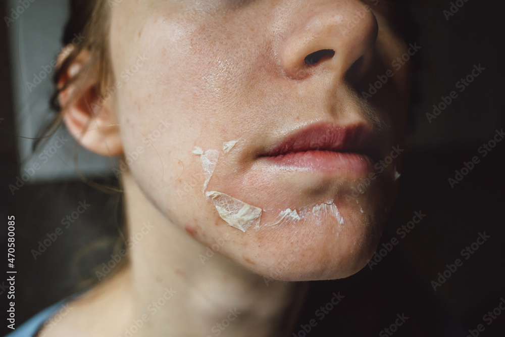 Woman's face after chemical peeling. Peeling skin on the face